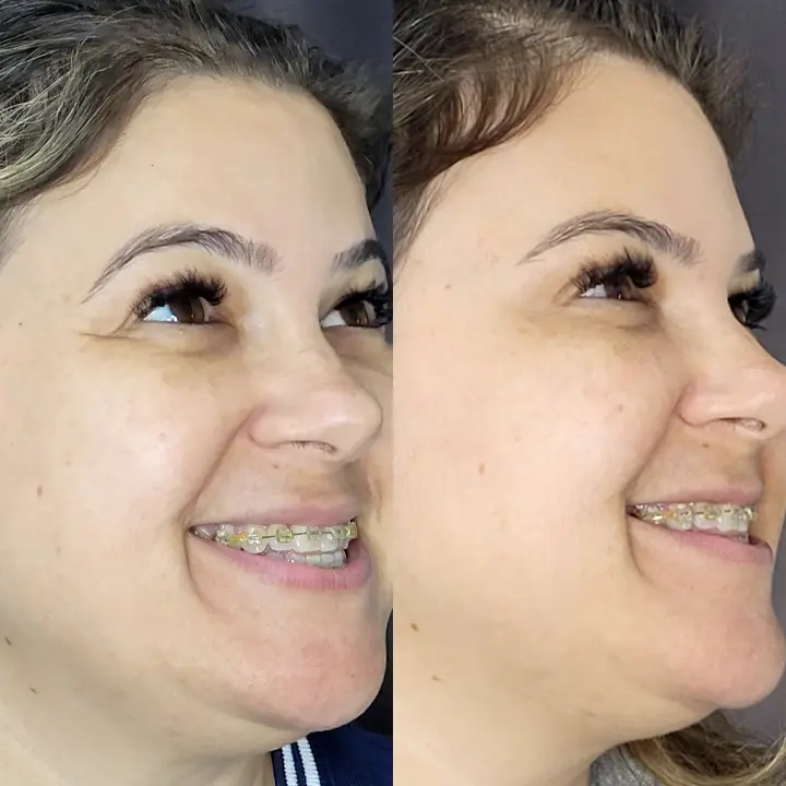 AnyConv.com__Botox-1