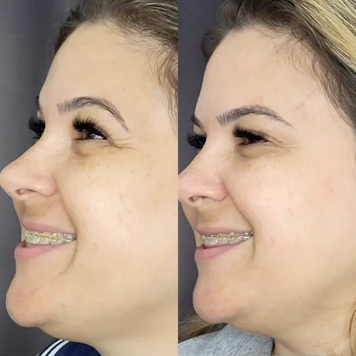 AnyConv.com__Botox-2