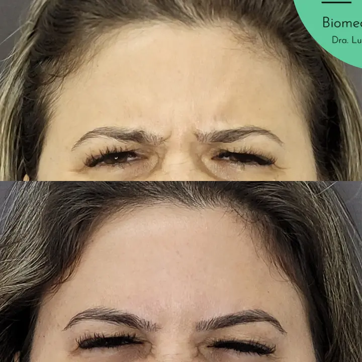 AnyConv.com__Botox-3